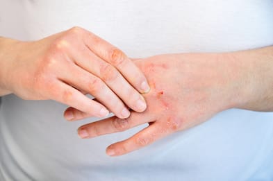 Dermatite Atopica, cos’è e perché è sbagliato sottovalutarla. VIDEO