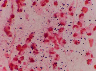 Bacteria Gram positive in sputum gram stain.red background.