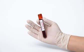 Blood collection tubes Group A Streptococcus test. strep A epidemic.