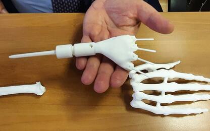 Roma, polso realizzato con stampante 3D: salvata la mano di una donna