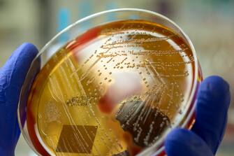 940512558 A microbiologist holding a blood agar plate showing the beta-hemolysis caused by pathogenic bacteria Streptococcus pyogenes. This bacteria can cause a variety of diseases such as scarlet fever, streptococcal pharyngitis, rheumatic fever, rheumatic heart disease, impetigo and acute postinfectious glomerulonephritis.