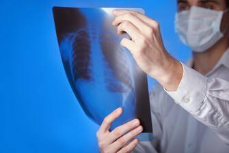 Male doctor in mask and  white coat holding  x-ray or roentgen of lungs, fluorography,  image  on blue background