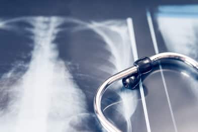 Tumori, presentate nuove linee guida europee per chirurgia ai polmoni