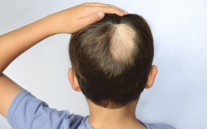 Giornata internazionale dell'alopecia, le cure più innovative