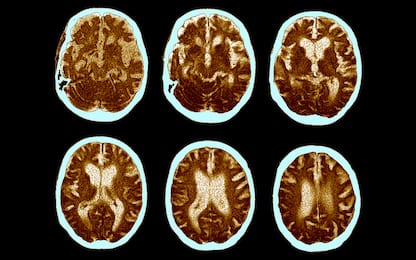 Alzheimer,  prevenzione può evitare o rallentare 40% casi di demenza