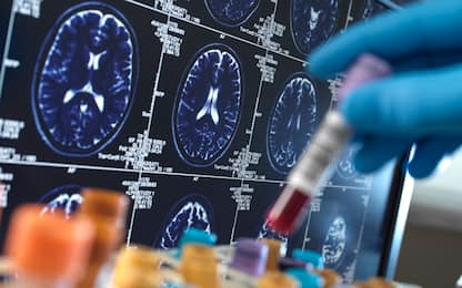 Alzheimer, studio su casi insorti a decenni da trattamenti medici