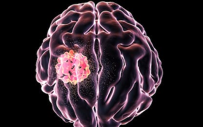 Cancro al cervello, cura innovativa ha cancellato un glioblastoma