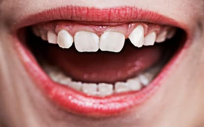 Denti, trattamento ortodontico: a che età iniziare?