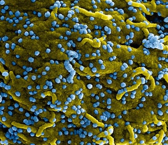 Colorized scanning electron micrograph of Marburg virus particles (blue) both budding and attached to the surface of infected VERO E6 cells (yellow). Image captured and color-enhanced at the NIAID Integrated Research Facility in Fort Detrick, Maryland. Credit: NIAID. (Photo by: IMAGE POINT FR/NIH/NIAID/BSIP/Universal Images Group via Getty Images)