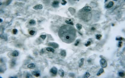 Usa, nuovo caso di meningite da ameba mangia cervello