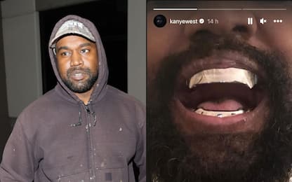 Kanye West: denti sostituiti con protesi in titanio?
