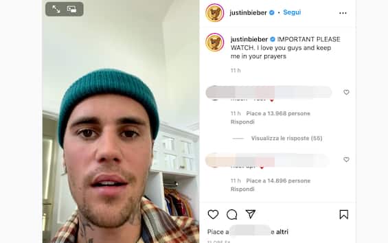 Justin Bieber with a paralyzed face: “I have Ramsay Hunt syndrome”.  VIDEO
