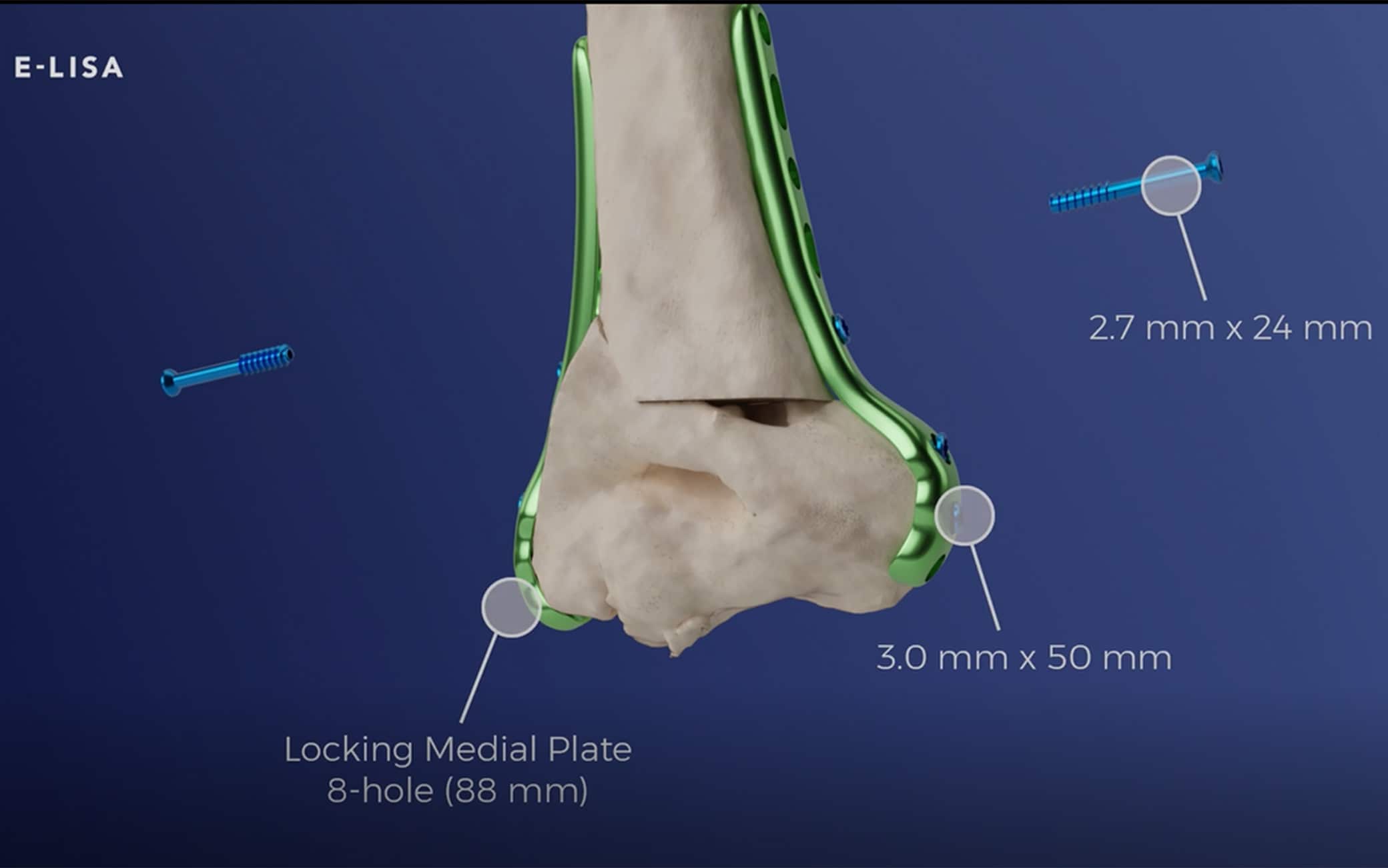 What is e-Lisa and how does it work, the startup that wants to revolutionize the world of orthopedics