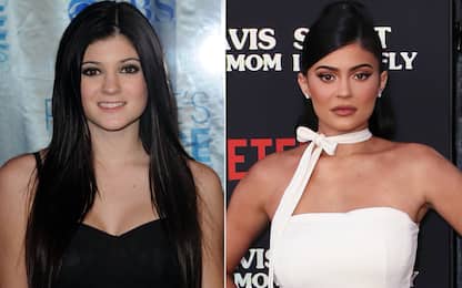 Kylie Jenner prima e dopo la chirurgia