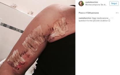 Nadia Fanchini shock: la cicatrice post-operazione