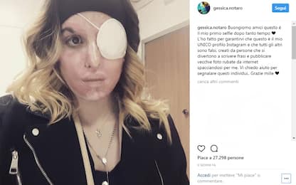 Sfregiata da ex, Gessica posta un selfie: "Il primo dopo tanto tempo"