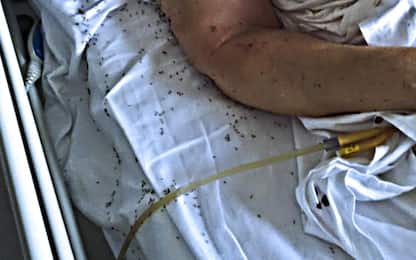 Napoli, denuncia dei Verdi: "Donna a letto in ospedale tra formiche"