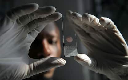 Malaria: cos'è e come si trasmette. SCHEDA