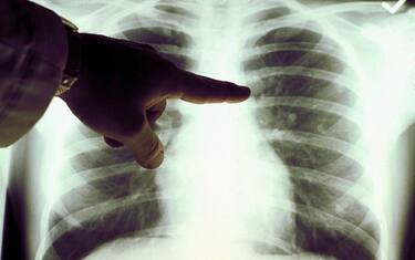 Tumore al polmone, con immuno-chemioterapia migliora sopravvivenza