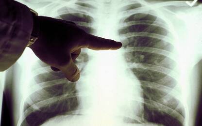 Tumore al polmone, triplicato il numero dei pazienti vivi dopo 5 anni
