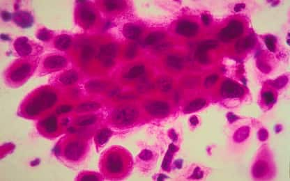 La proteina Tox rafforza le cellule immunitarie indebolite dai tumori