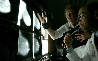 Tumore al seno iniziale, studio: si può evitare chemio in 70% dei casi
