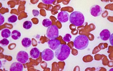 Leucemia linfoblastica, nuove speranze dalle cellule CARCIK