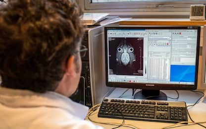 Parkinson, i danni cerebrali dietro i comportamenti dei malati