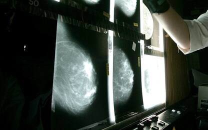 Tumore al seno, paziente curata con cellule "istruite" contro malattia